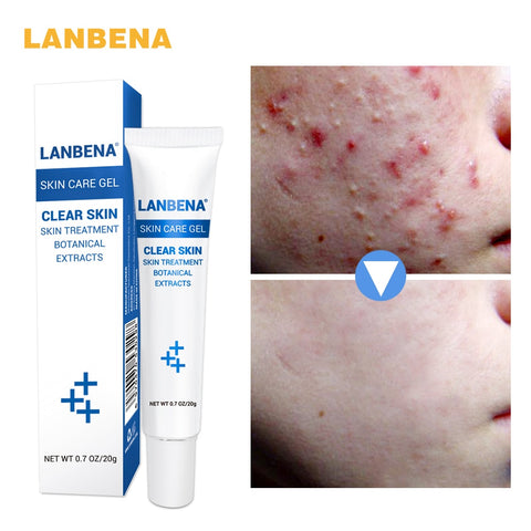 LANBENA Anti Acne Moisturizing